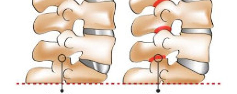 La sindrome delle faccette articolari